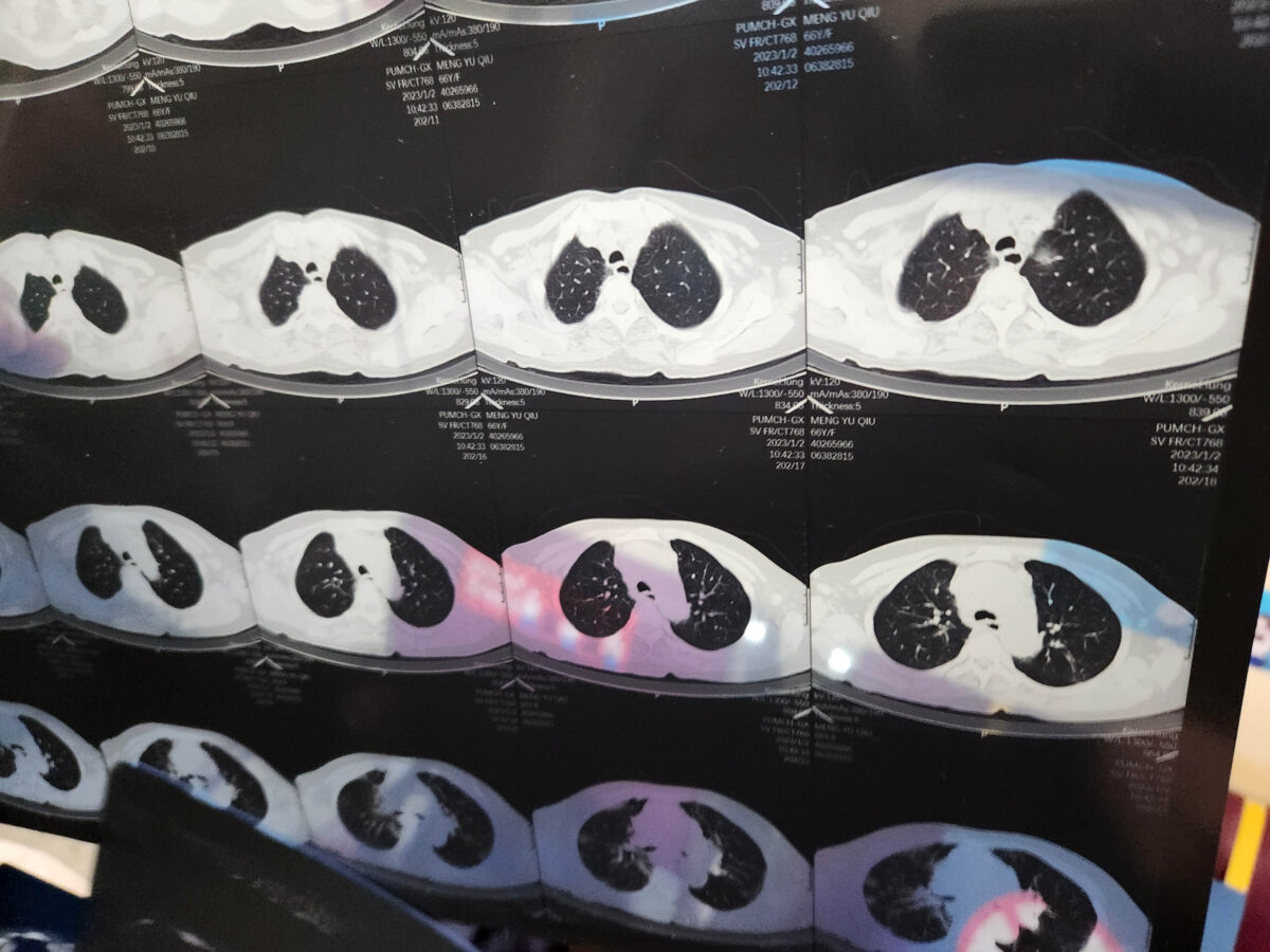 Một bác sĩ xem ảnh chụp CT của một bệnh nhân ở Hải Điến, Bắc Kinh, Trung Quốc, hôm 02/01/2023. (Ảnh: CFOTO/Future Publishing qua Getty Images)