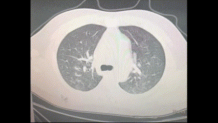 Chụp cắt lớp vi tính phổi của nguồn tin tại hiện trường sau khi xuất hiện các triệu chứng giống như bệnh cúm vào giữa tháng 12/2022. (Ảnh: The Epoch Times)