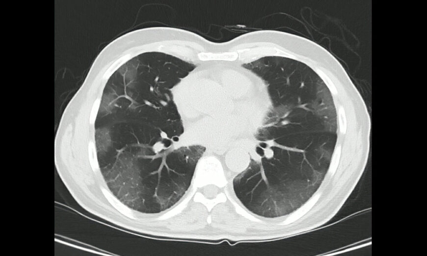 Chụp cắt lớp vi tính (chụp CT) vùng ngực trong một trường hợp được xác nhận nhiễm COVID-19. (Ảnh: Shutterstock)