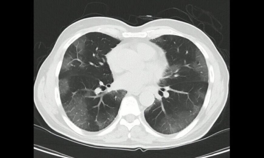Dấu hiệu nhận biết bệnh phổi trắng (Ảnh: Shutterstock)