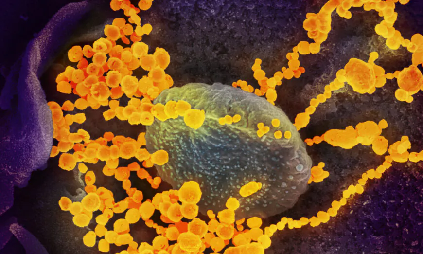 Kính hiển vi điện tử cho thấy hình ảnh về SARS-CoV-2 (vật thể hình tròn màu vàng), virus gây bệnh COVID-19, xuất hiện trong các tế bào nuôi cấy. (Ảnh: NIAID qua The Epoch Times)