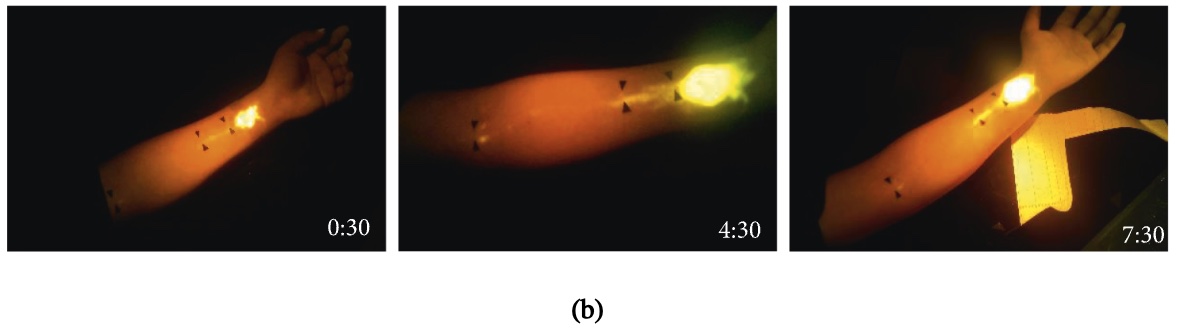 Hình b: Fluorescein di chuyển dọc theo kinh lạc huyệt vị của cơ thể con người, chất huỳnh quang tại PC3 (Khúc Trạch) xuất hiện tại đường tuyến tính giữa PC3 và PC4 (Khích Môn), cho thấy sự tích tụ bất thường của fluorescein tại huyệt Khúc Trạch. (Ảnh: Li, et al. eCAM 2021. https://doi.org/10.1155/2021/5581227)