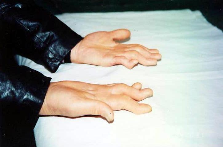 Bàn tay của một học viên Pháp Luân Công bị tàn tật sau khi bị treo bằng dây thừng trong thời gian dài. (Ảnh: Được đăng dưới sự cho phép của Minghui.org)