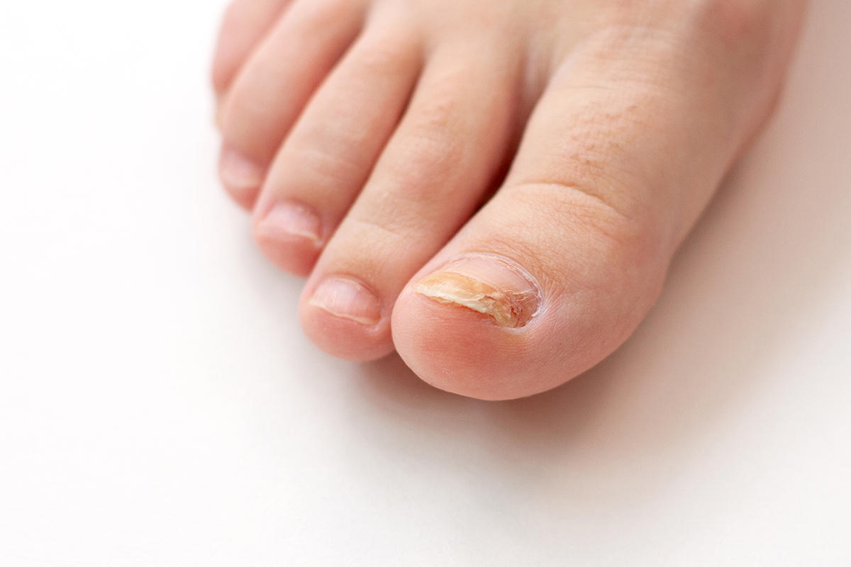 Móng chân của bạn có bị nứt và dễ gãy? Bí quyết chống nấm móng